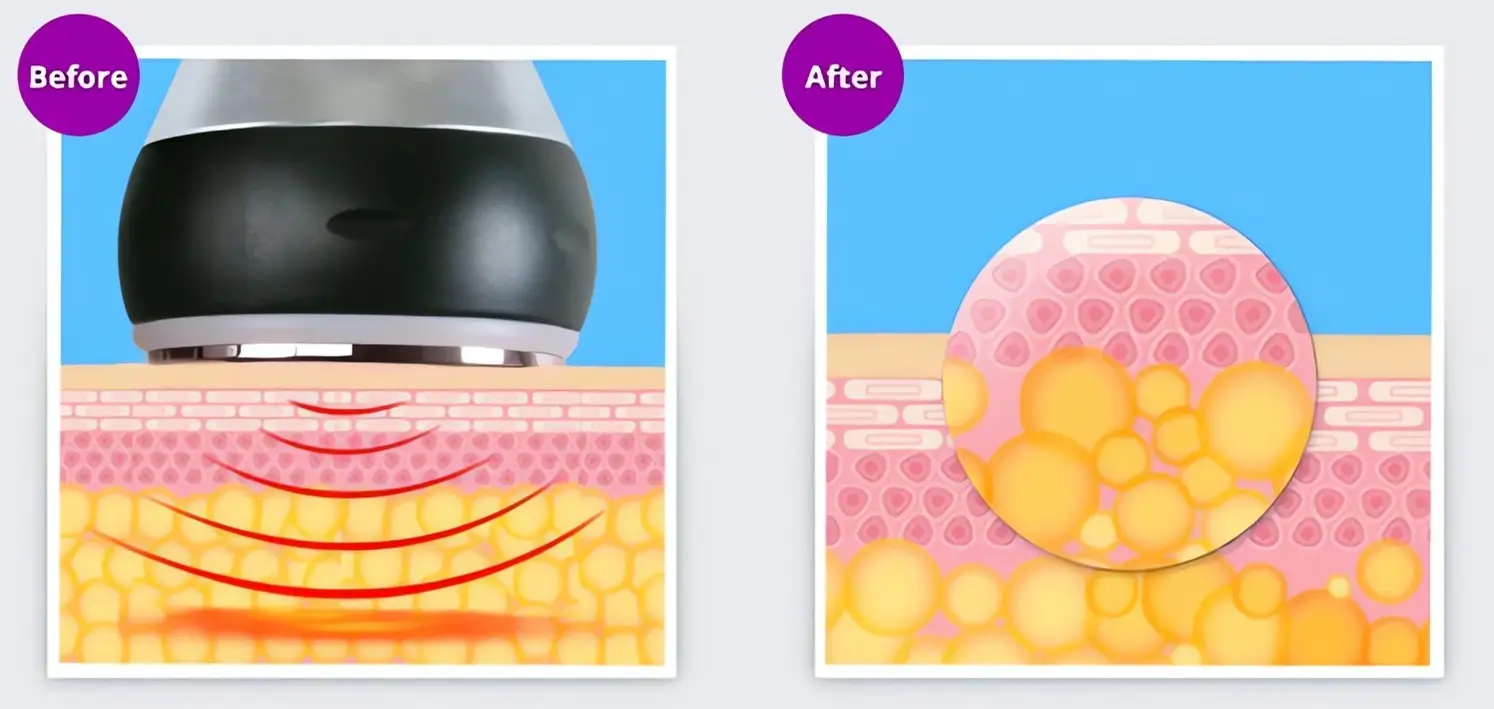 ultrasonic fat cavitation