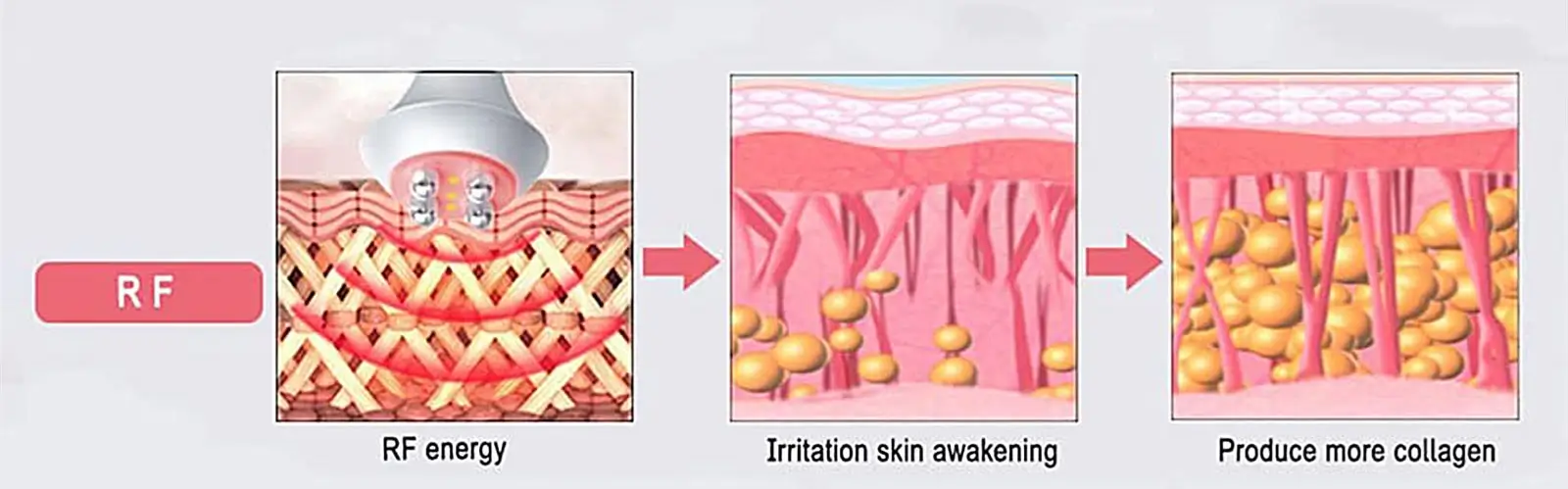 rf cavitation machine